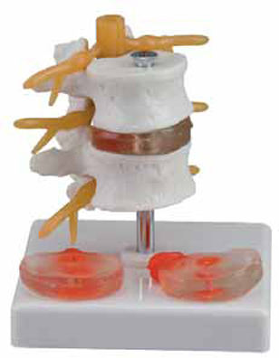 2 Lumbar Vertebrae with Hernia and Prolapsed Intervertebral Disc